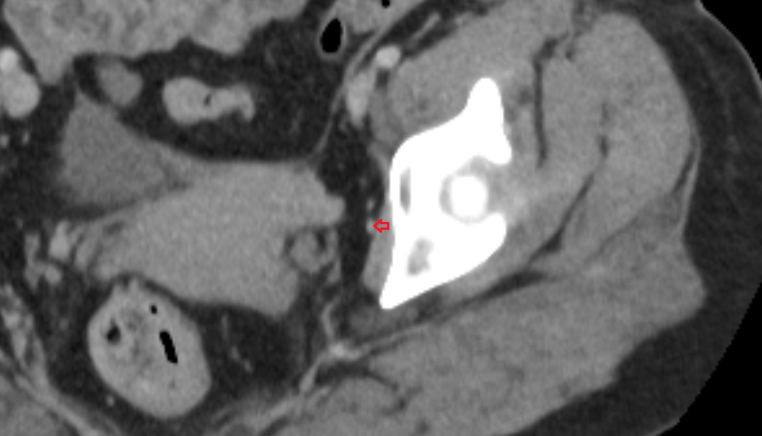 Obturator veins  CT  axial  anatomy  image-img-00000-00000