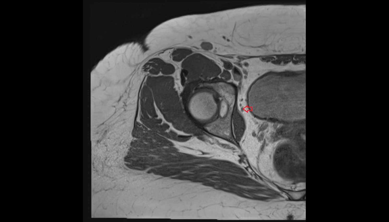 Obturator veins  MRI  axial  anatomy  image-img-00000-00000