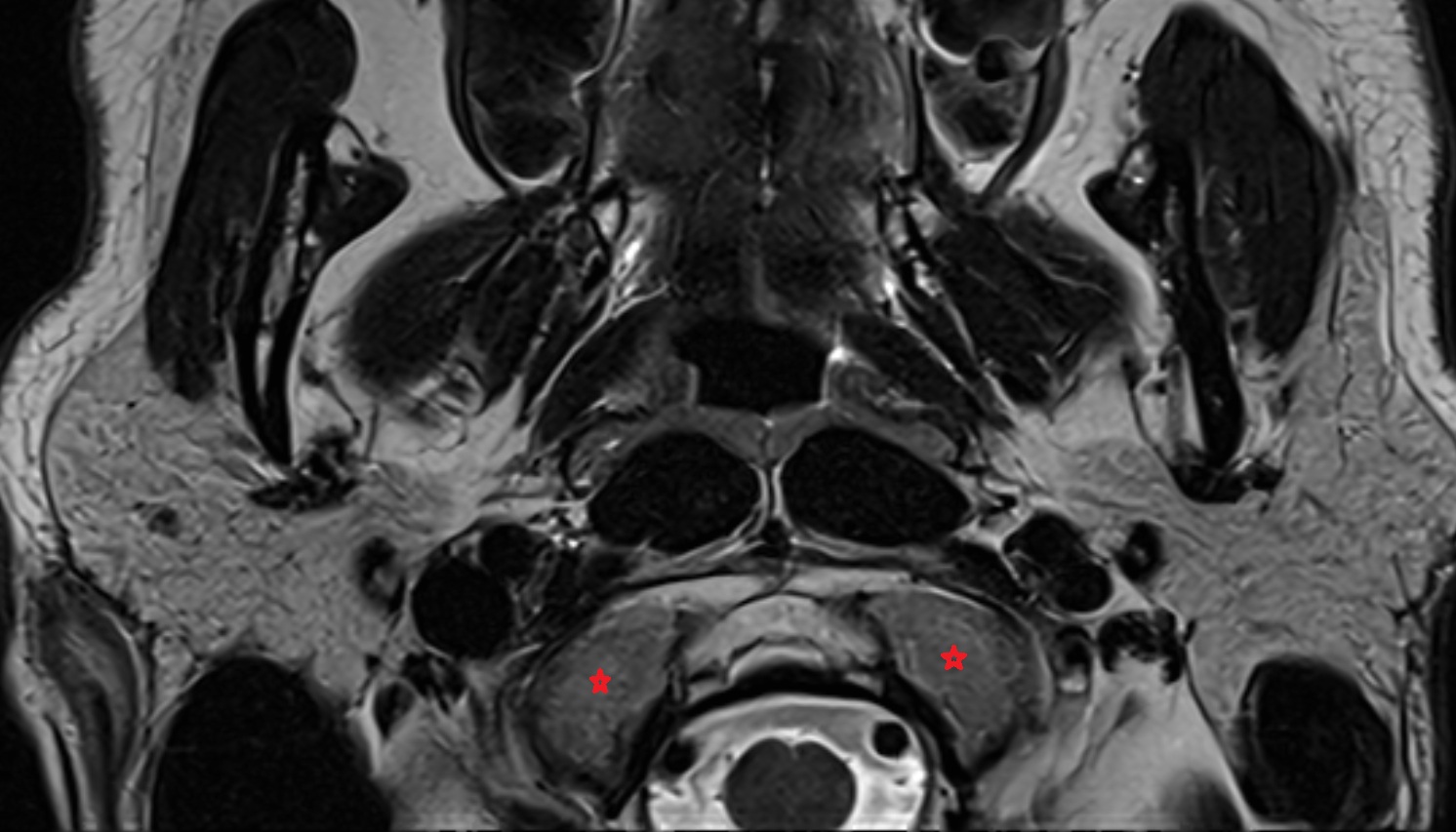 Occipital Condyle mri axial  image -img-00000-00000