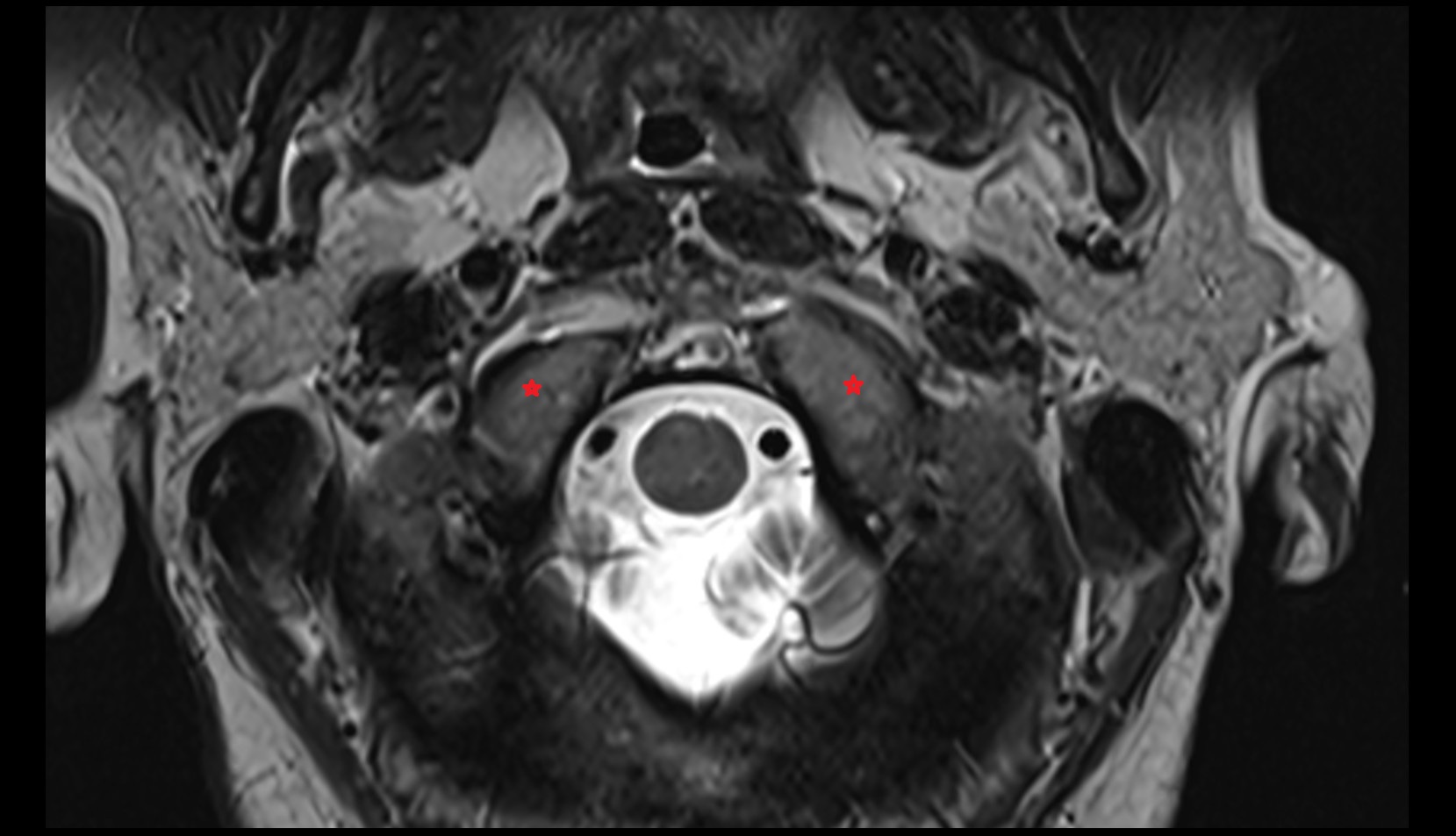 Occipital Condyle mri axial image