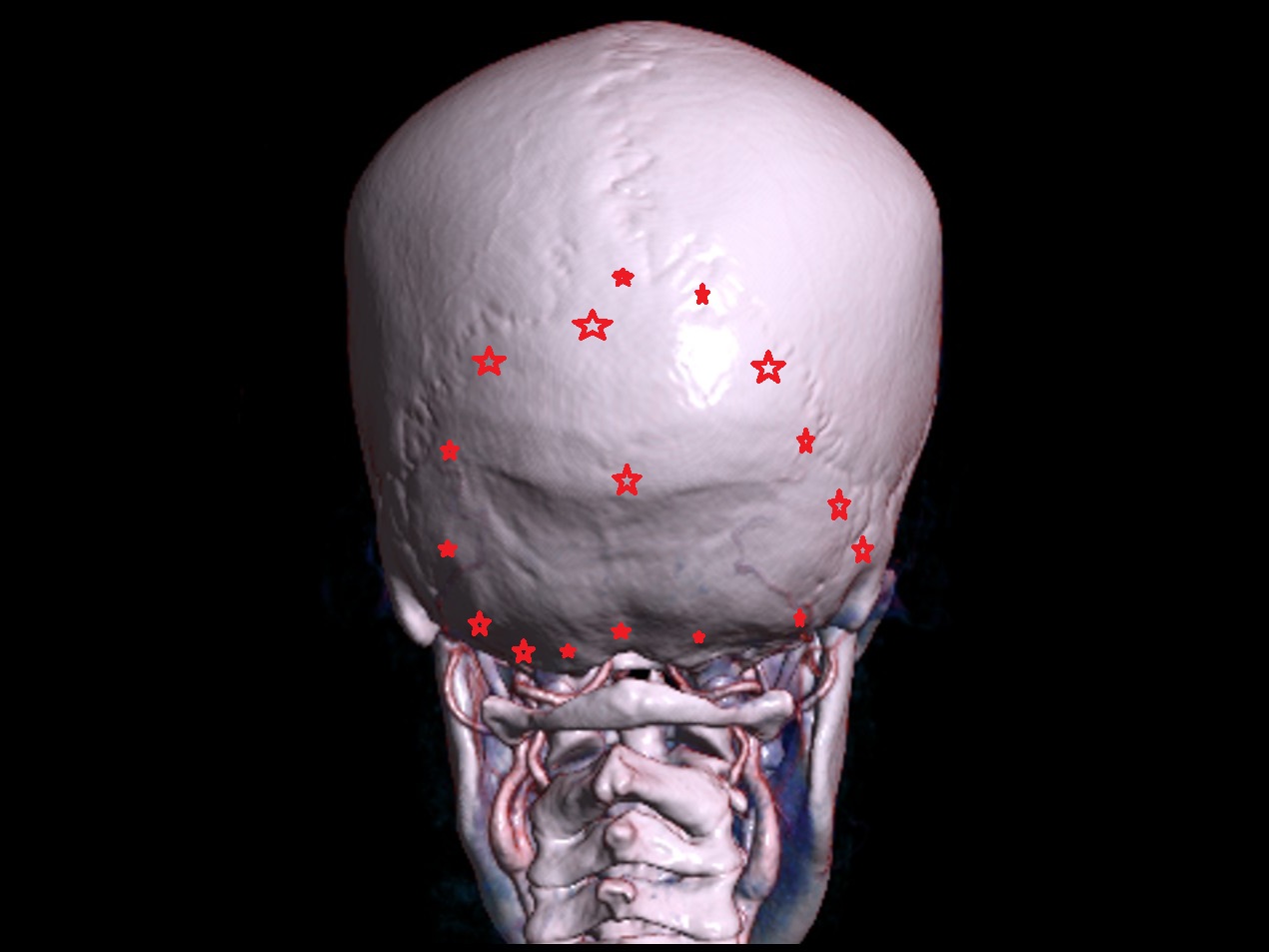 Occipital bone
