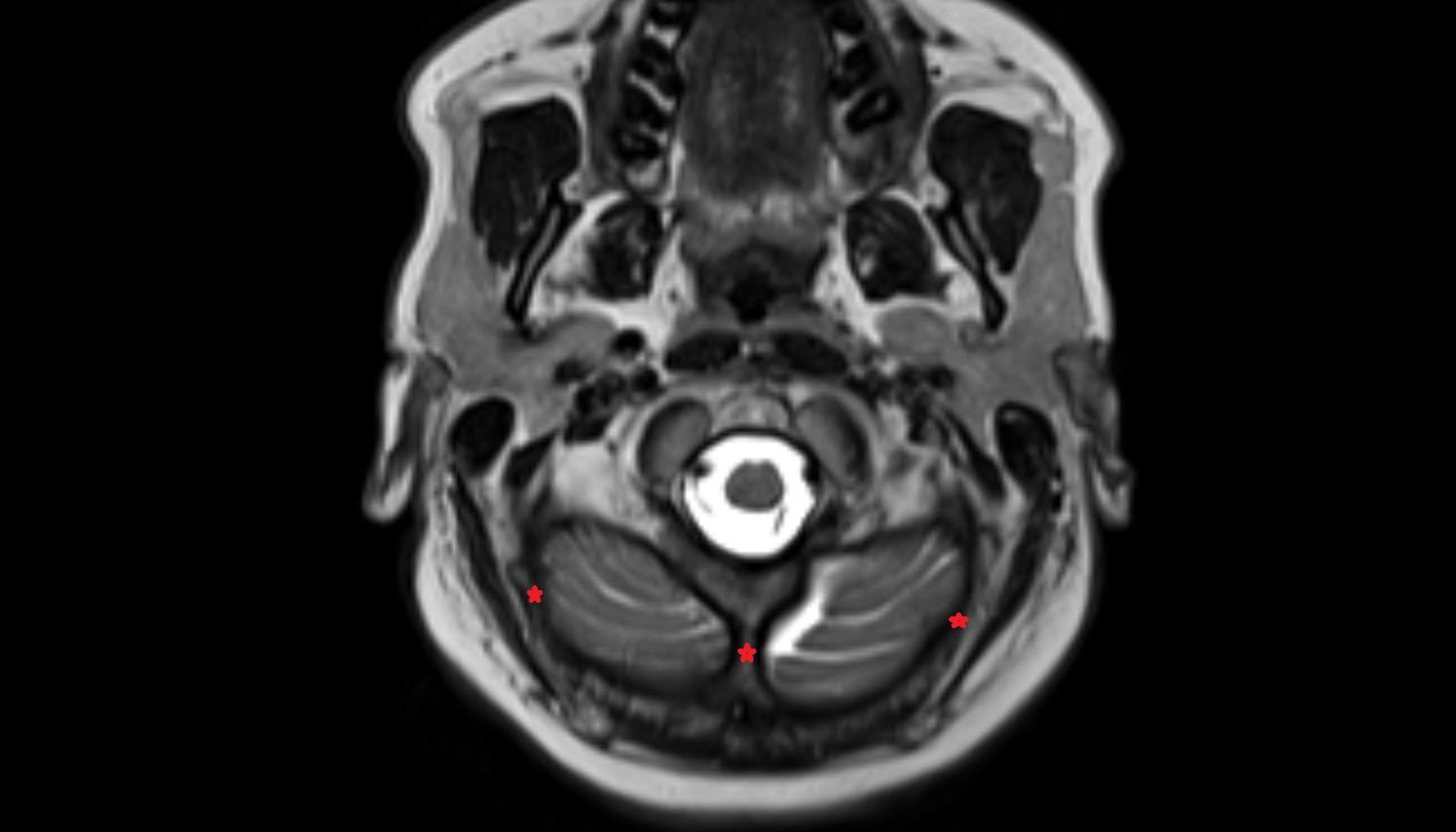 Occipital bone mri axial  image -img-00000-00000