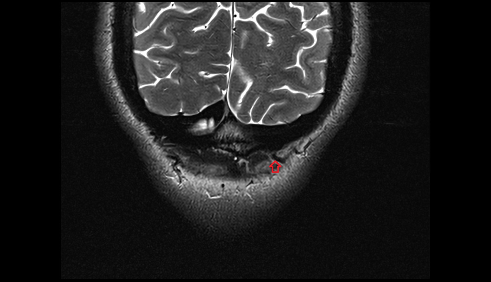 Occipital emissary vein MRI 3T coronal image
