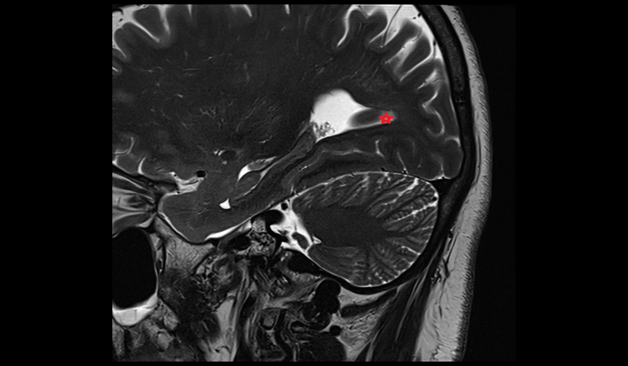 Occipital horn of lateral ventricle; Posterior horn of lateral ventricle mri 3t sagittal image