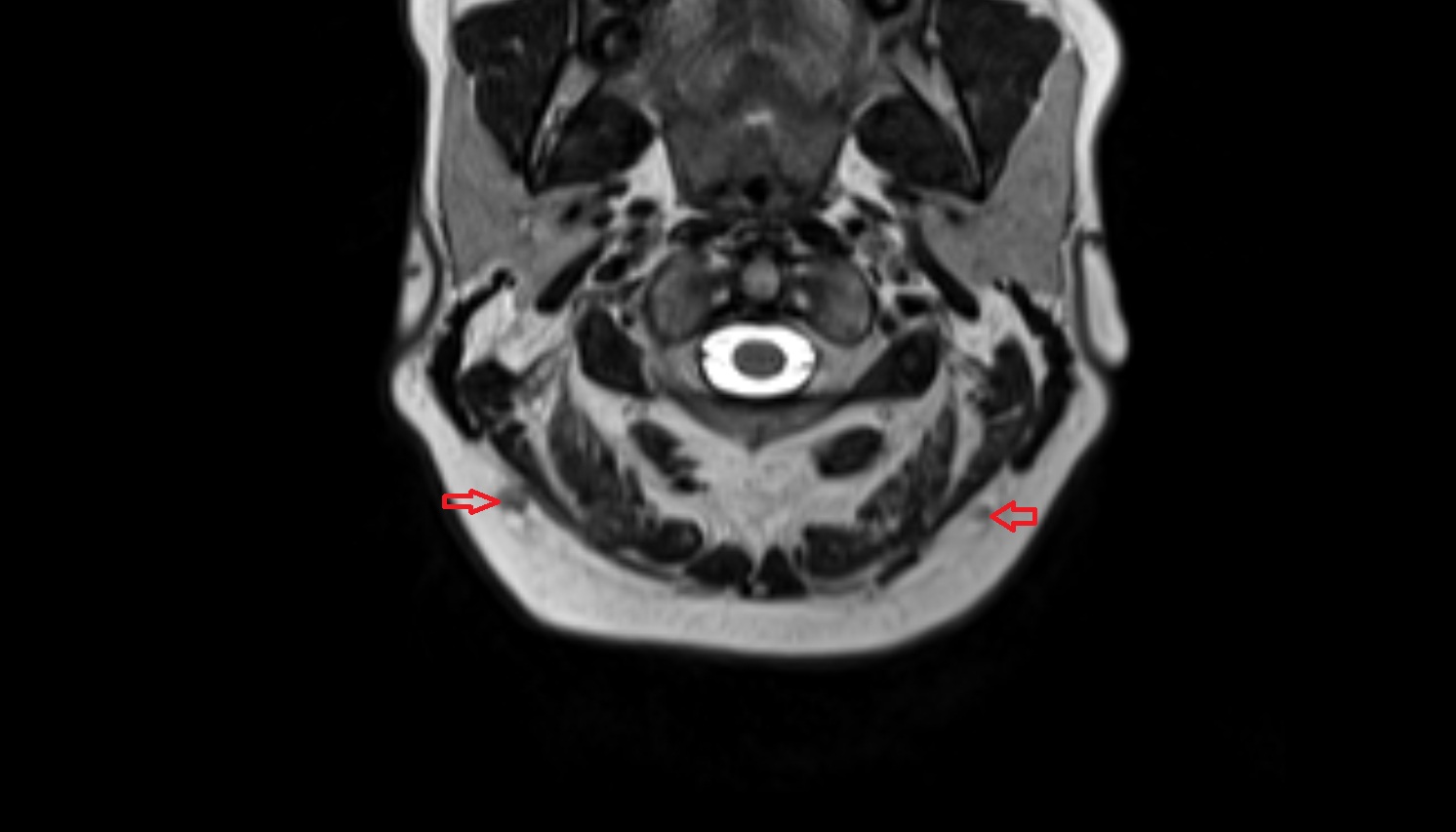 Occipital lymph nodes  mri axial  image -img-00000-00000