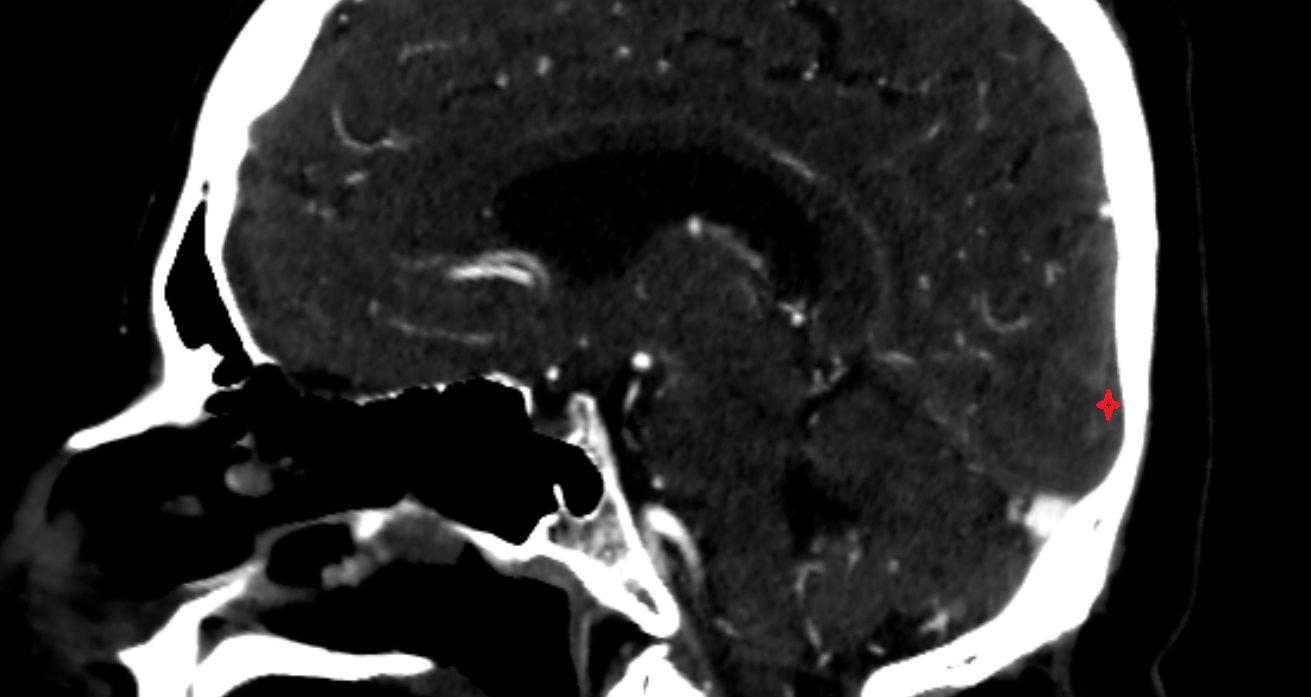 Occipital pole  CT sag anatomy image -img-00001-00001