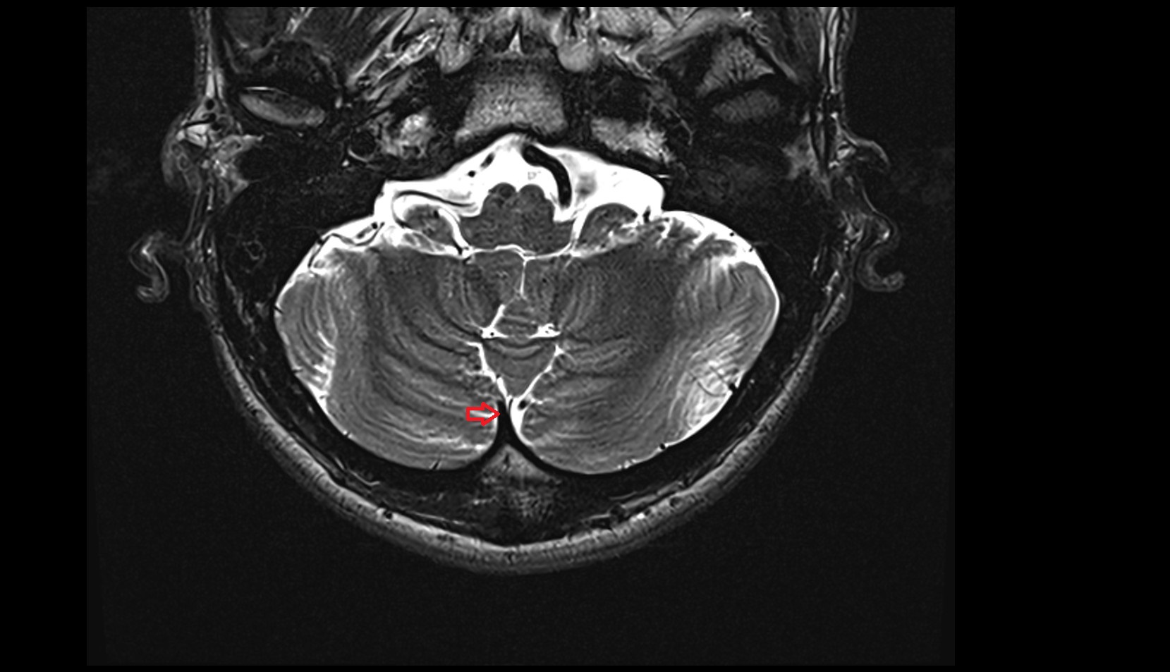 Occipital sinus MRI 3T axial image