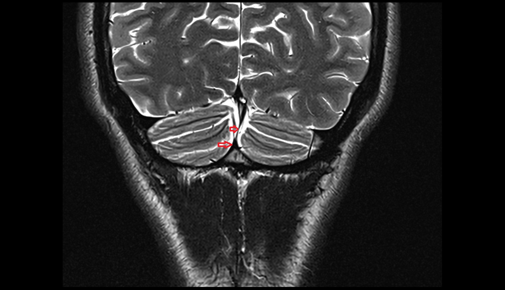 Occipital sinus MRI 3T coronal image