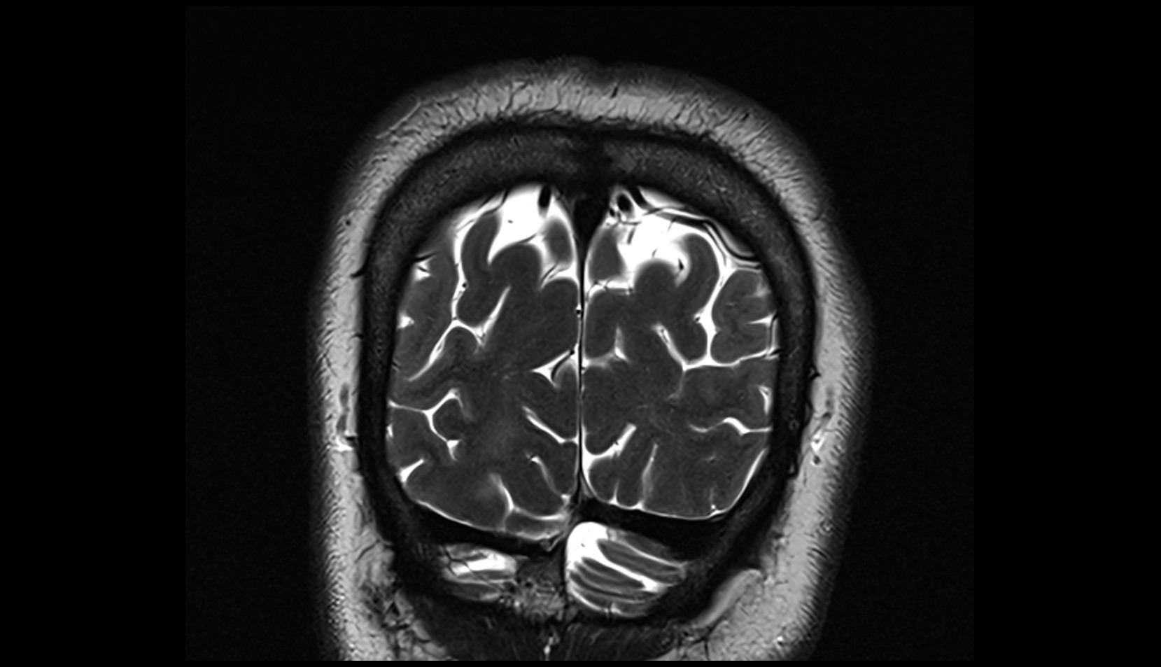 Occipital veins MRI 3T coronal image