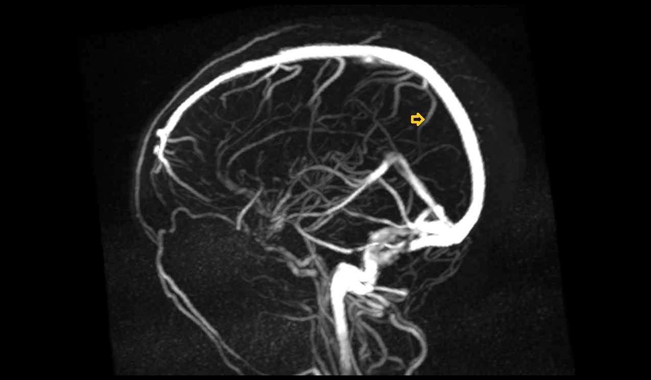 Occipital veins MRI 3T sagittal mip image