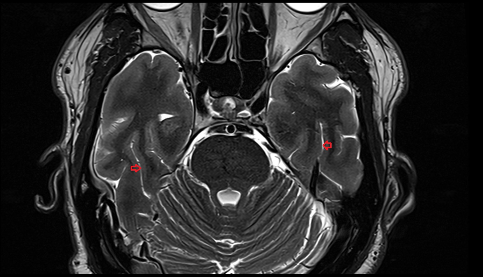 Occipitotemporal sulcus MRI 3T axial image