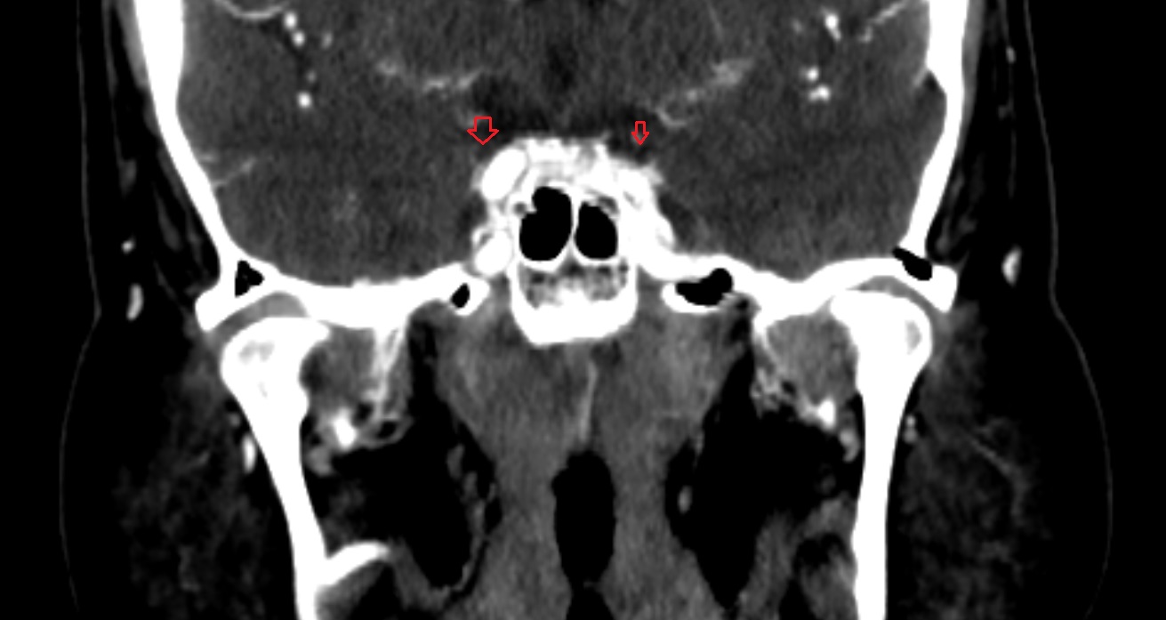 Oculomotor cistern  CT coronal anatomy image -img-00001-00001