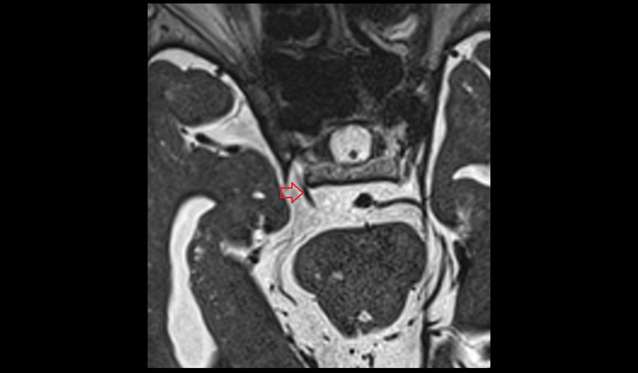 Oculomotor nerve (Cranial nerve III) 3T MRI axial image