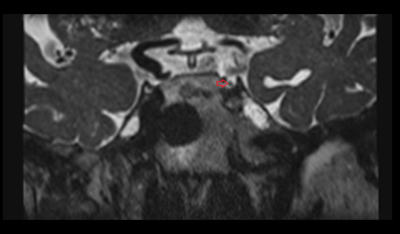 Oculomotor nerve (Cranial nerve III) 3T MRI coronal image
