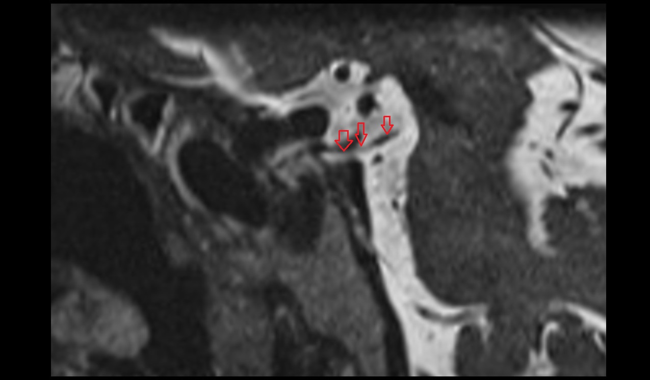 Oculomotor nerve (Cranial nerve III) 3T MRI sagittal image