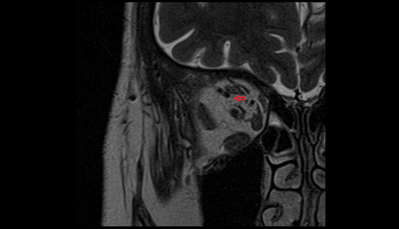 Oculomotor nerve (Superior branch) mri image