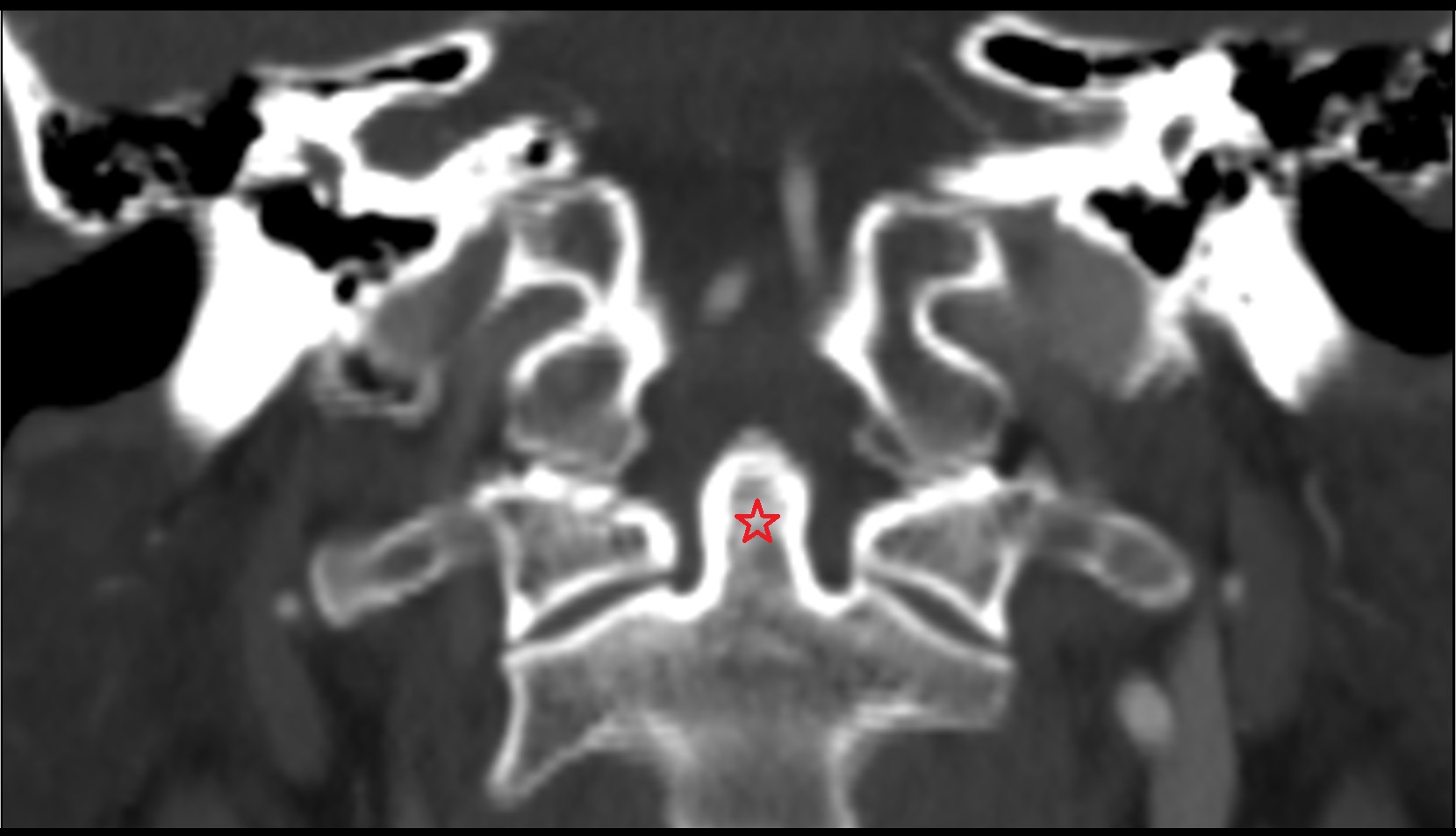 Odontoid process CT coronal