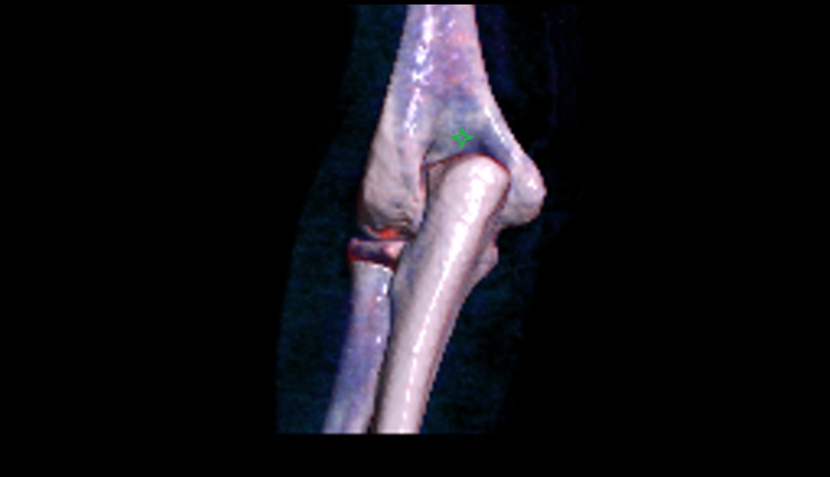 Olecranon fossa 3d vrt image