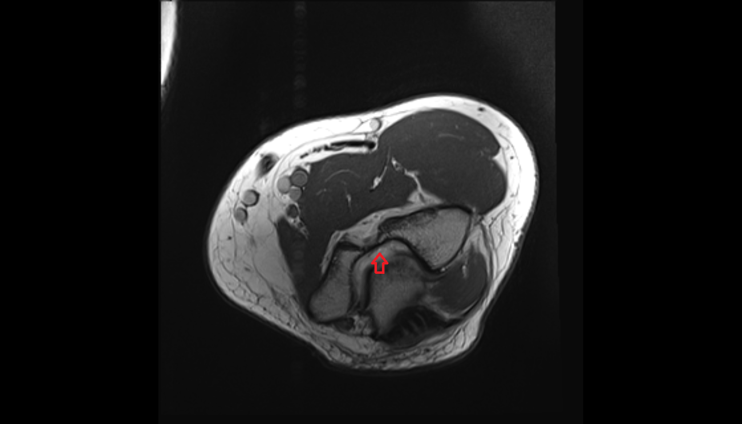 Olecranon fossa  axial cross sectional anatomy 3T MRI AI enhanced radiology image -img-00000-00000
