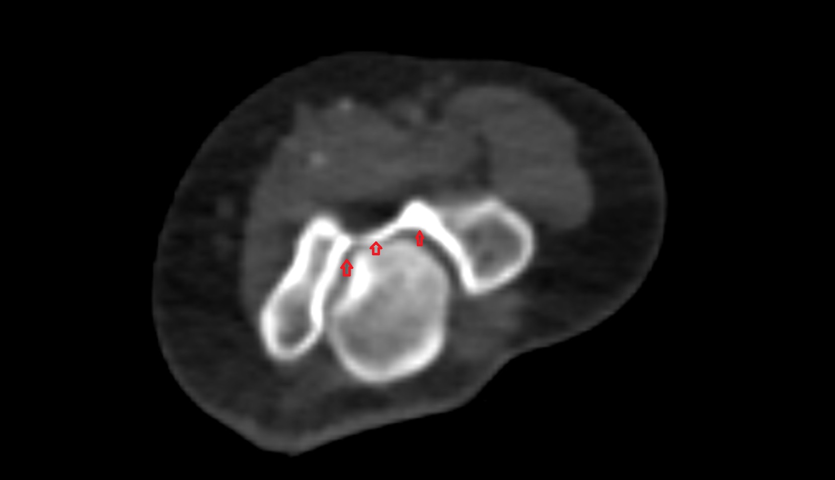 Olecranon fossa ct axial iamge