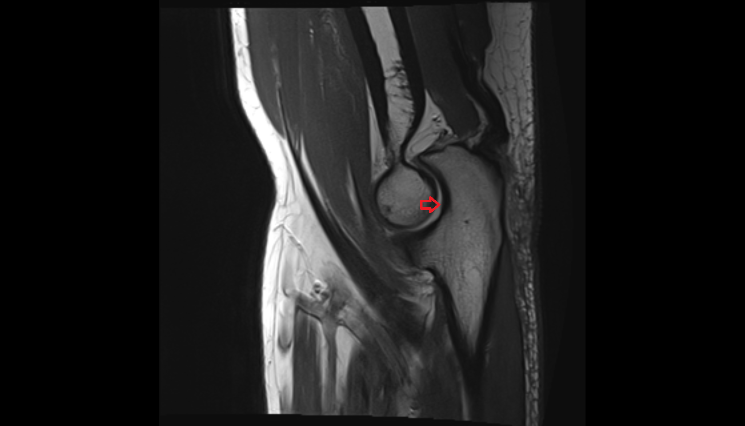 Olecranon fossa  sagl cross sectional anatomy 3T MRI AI enhanced radiology image -img-00000-00000