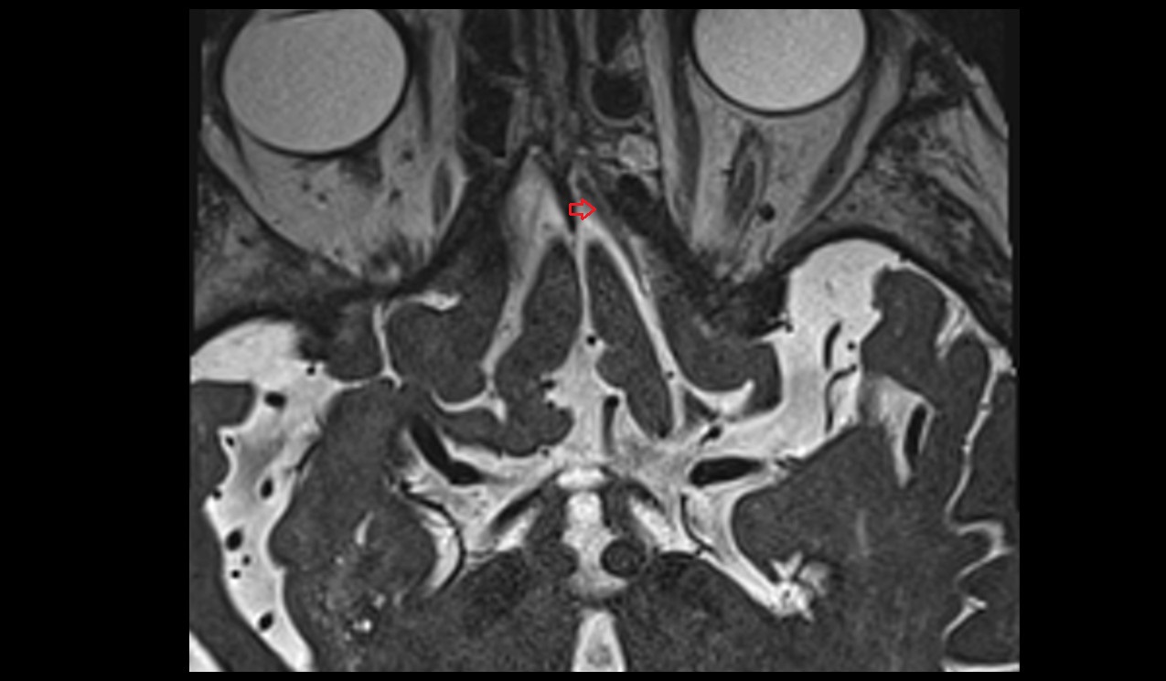 Olfactory bulb MRI 3T axial image