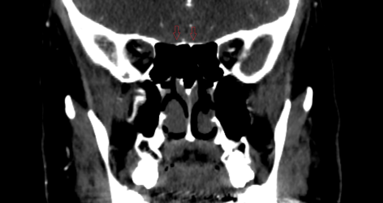 Olfactory cistern CT coronal anatomy image -img-00001-00001