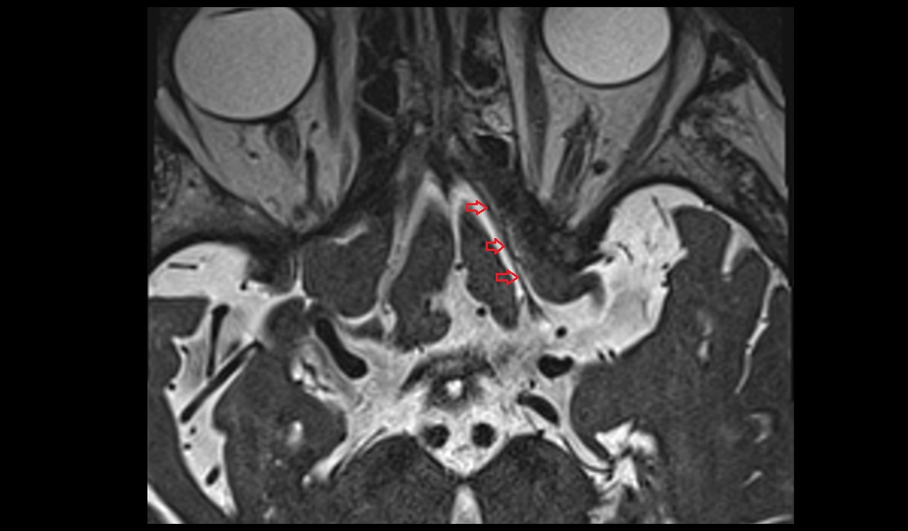 Olfactory tract MRI 3T axial image