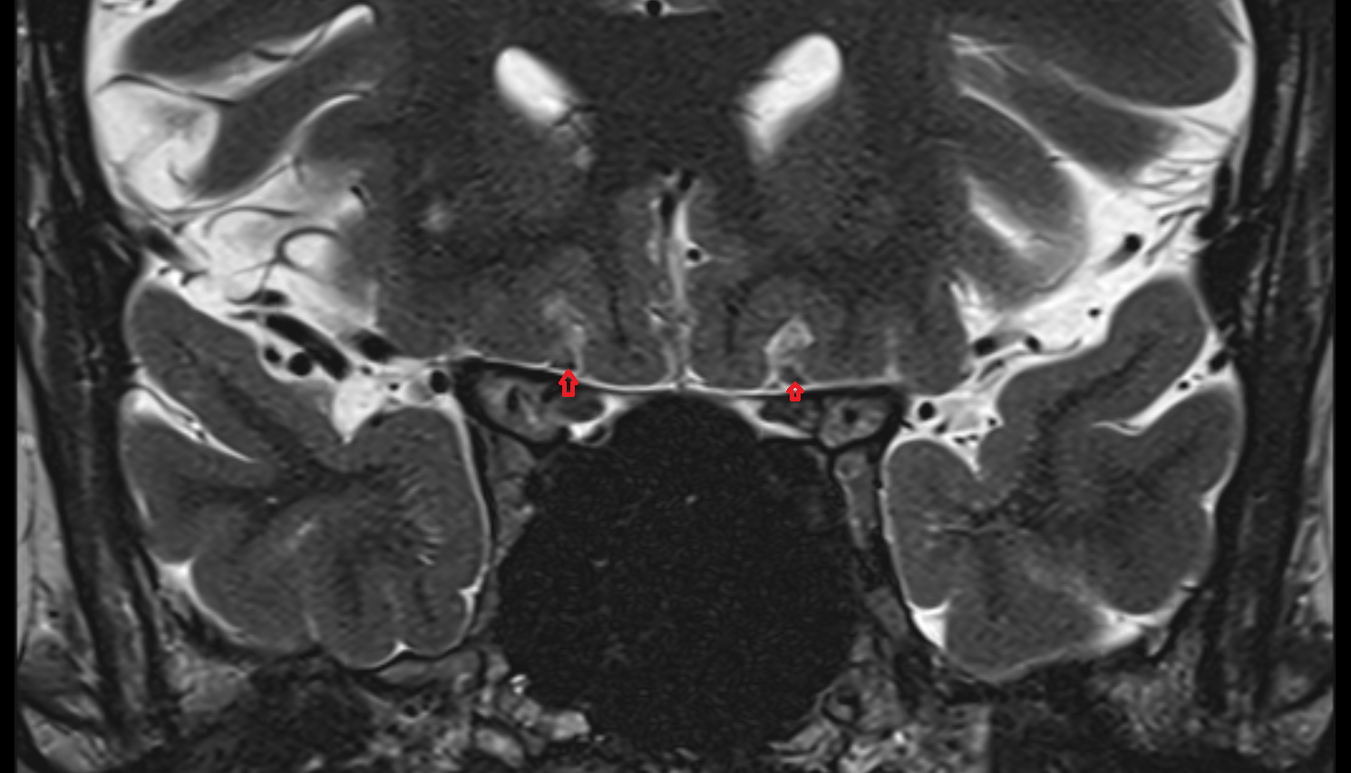 Olfactory trigone-img-00000-00000