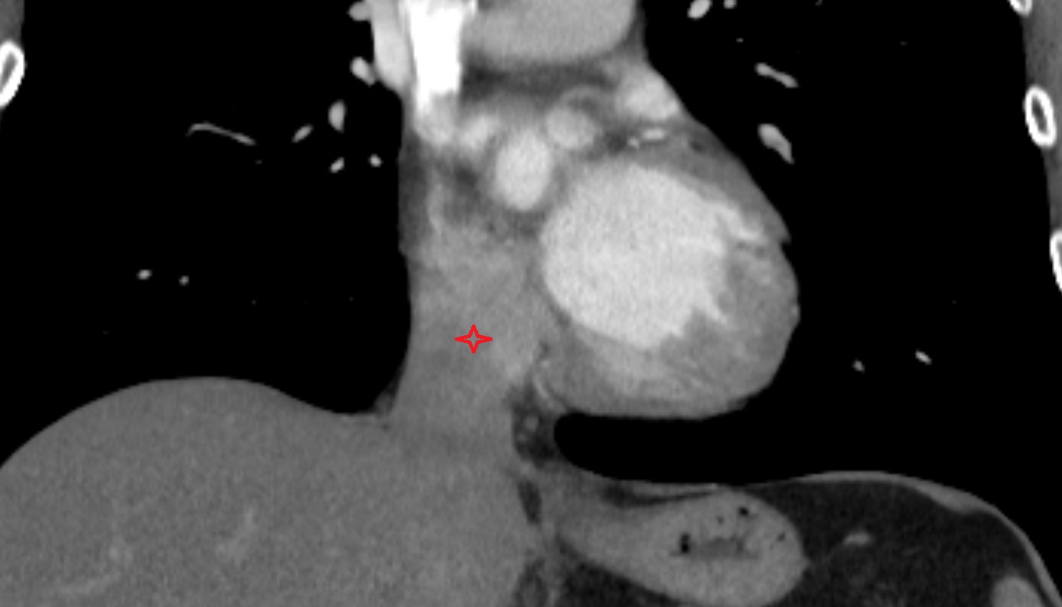 Opening of inferior vena cava  anatomy CT CORONAL  image -img-00000-00000