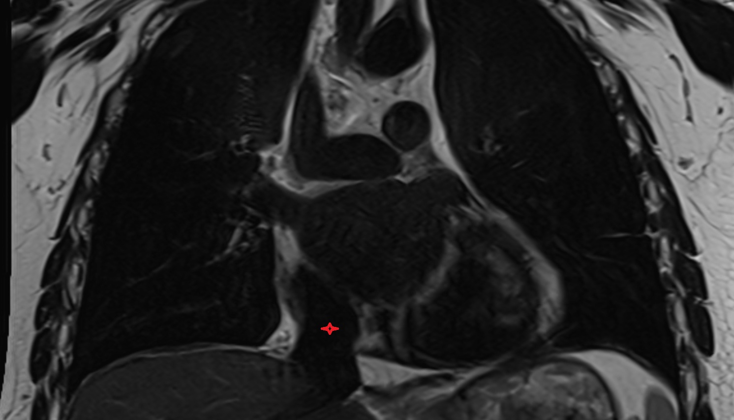Opening of inferior vena cava  anatomy  MRI  CORONAL image -img-00000-00000