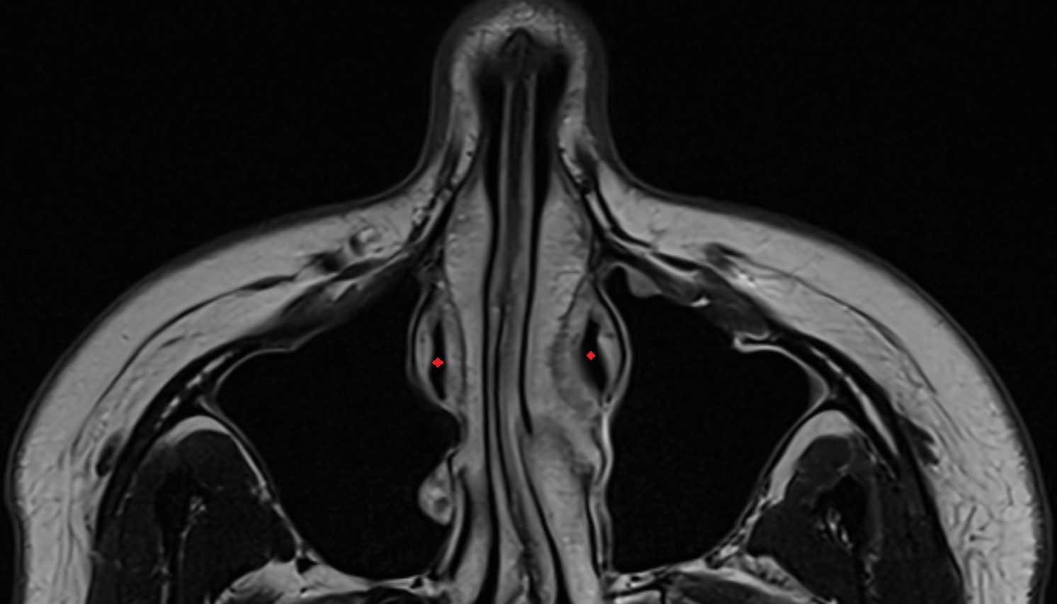 Opening of nasolacrimal duct axial mri image -img-00000-00000