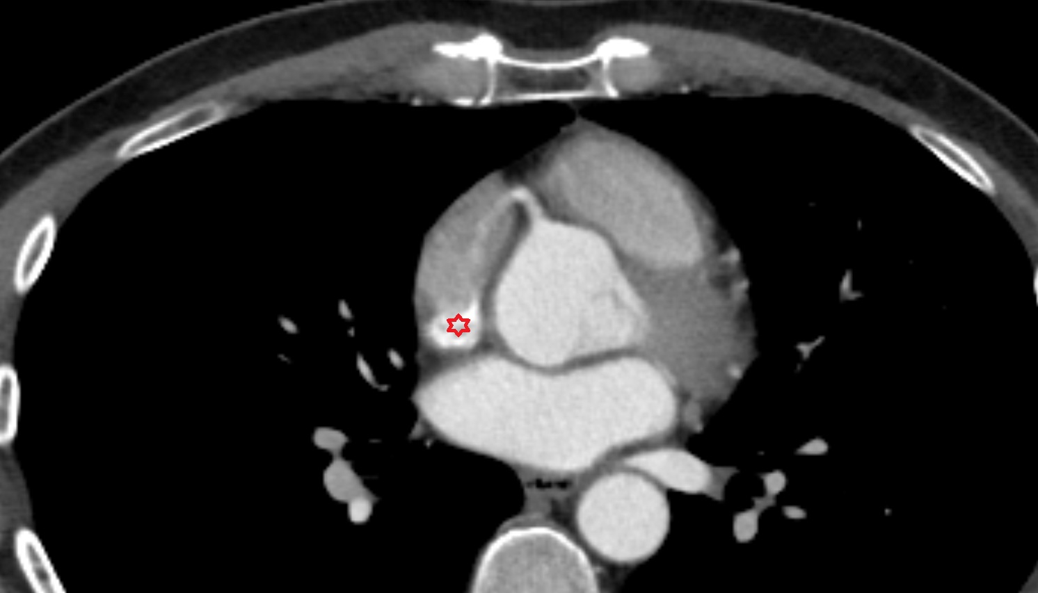 Opening of superior vena cava  anatomy CT AXIAL  image -img-00000-00000