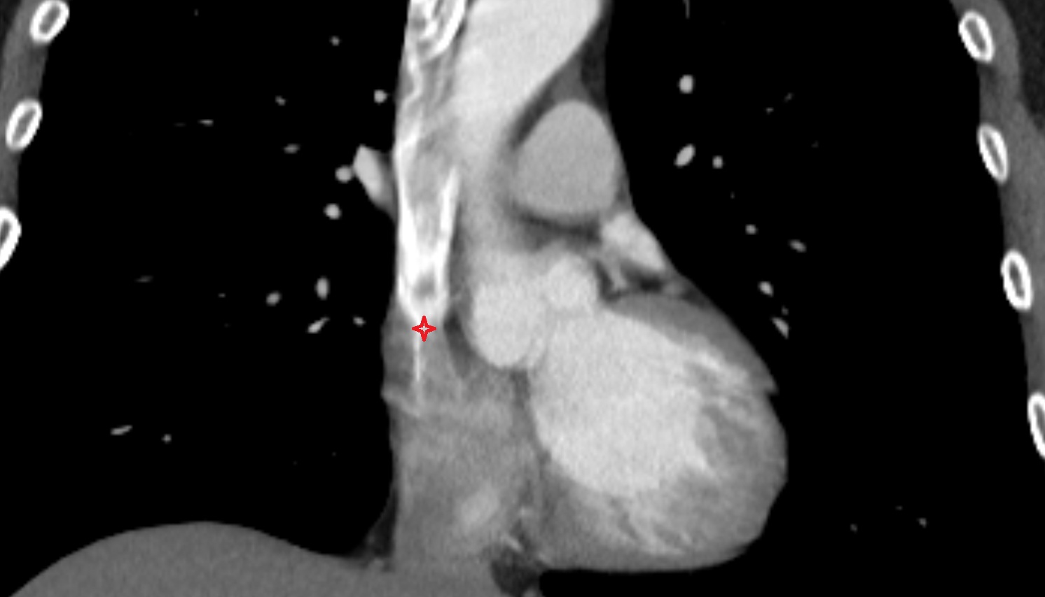 Opening of superior vena cava  anatomy CT CORONAL  image -img-00000-00000