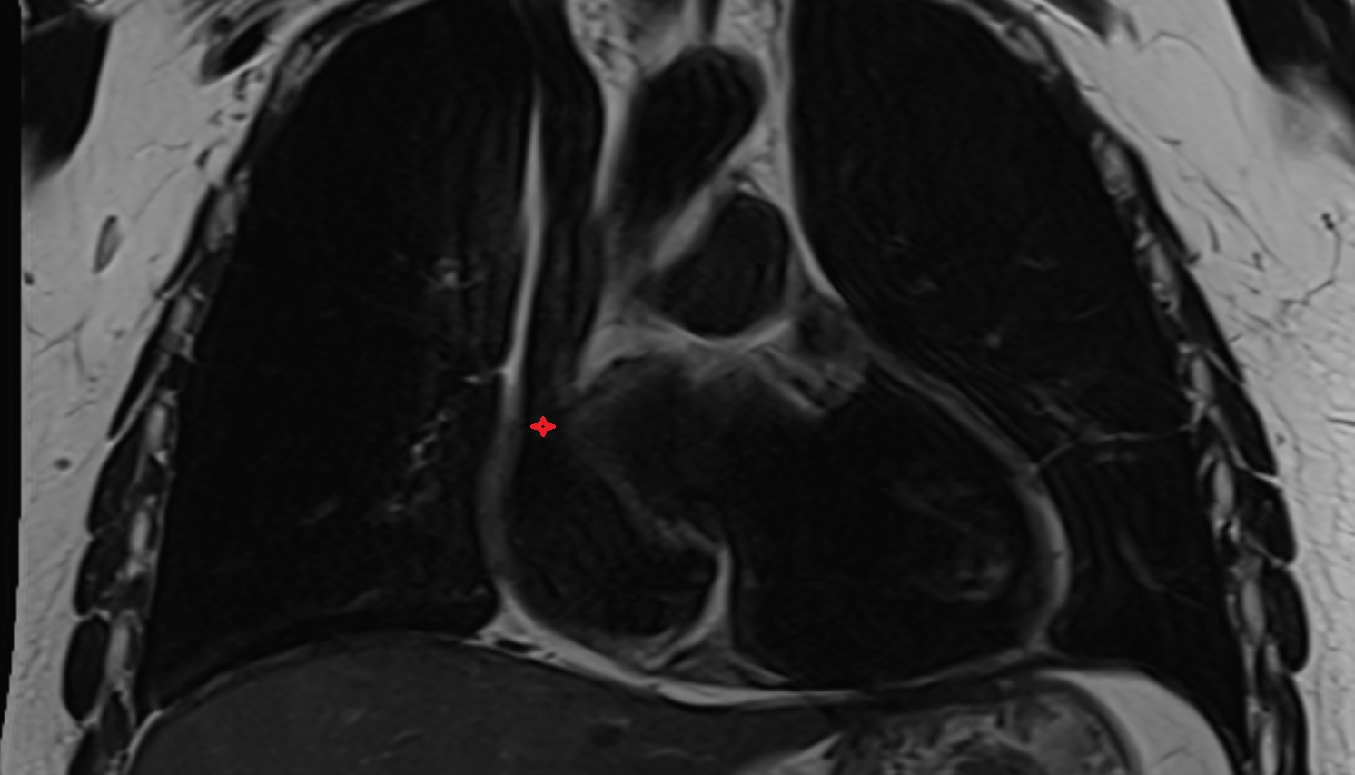 Opening of superior vena cava  anatomy  MRI  CORONAL image -img-00000-00000