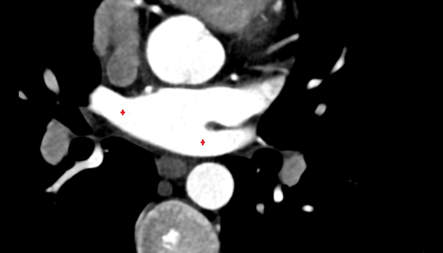 Openings of pulmonary veins  CT axial   image -img-00000-00000