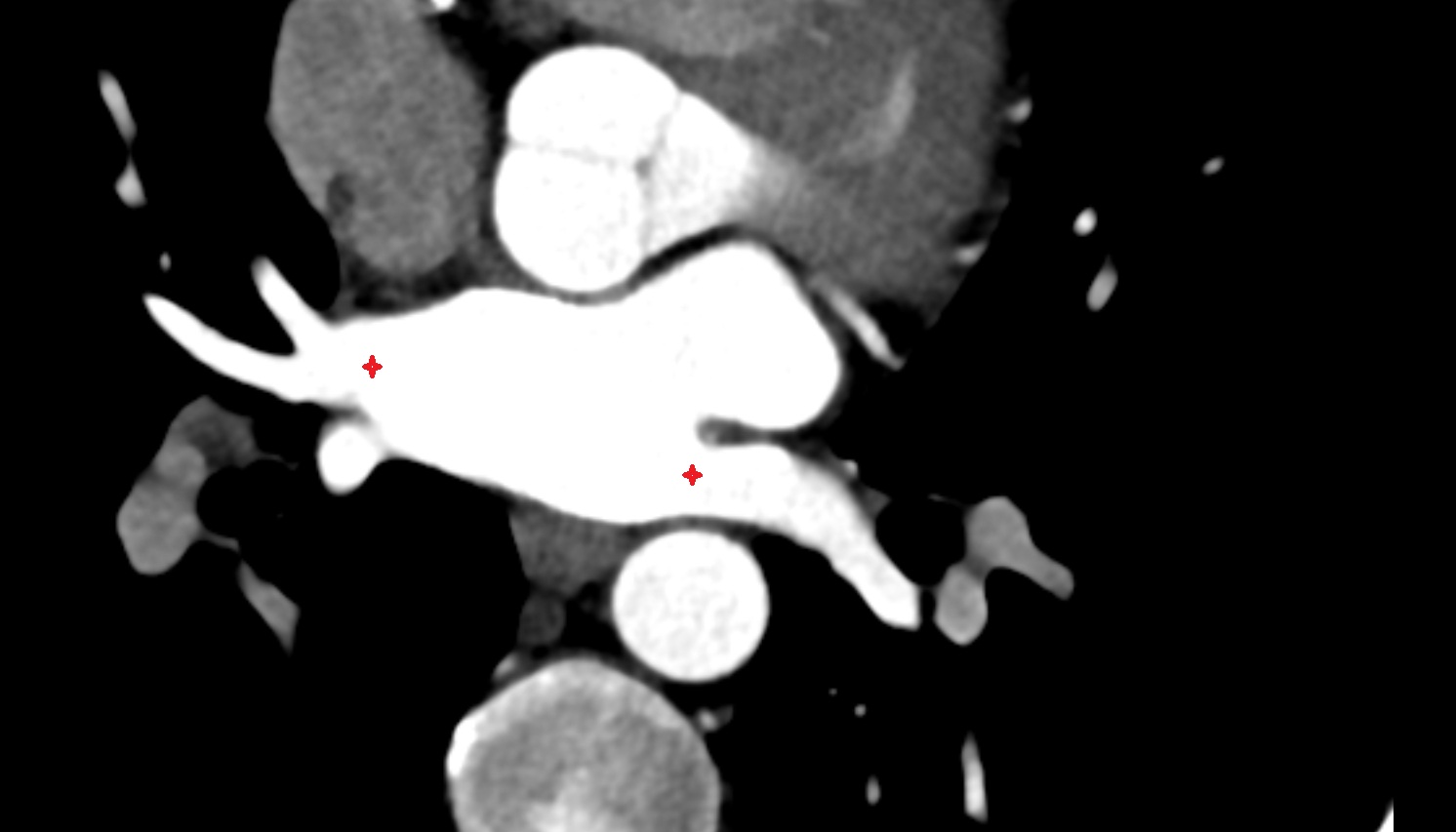 Openings of pulmonary veins  CT axial   image -img-00000-00000_00001
