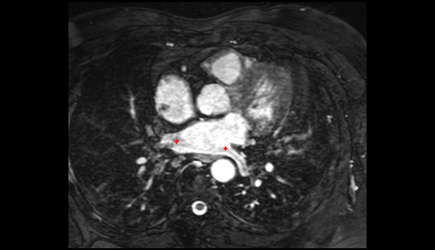 Openings of pulmonary veins mri