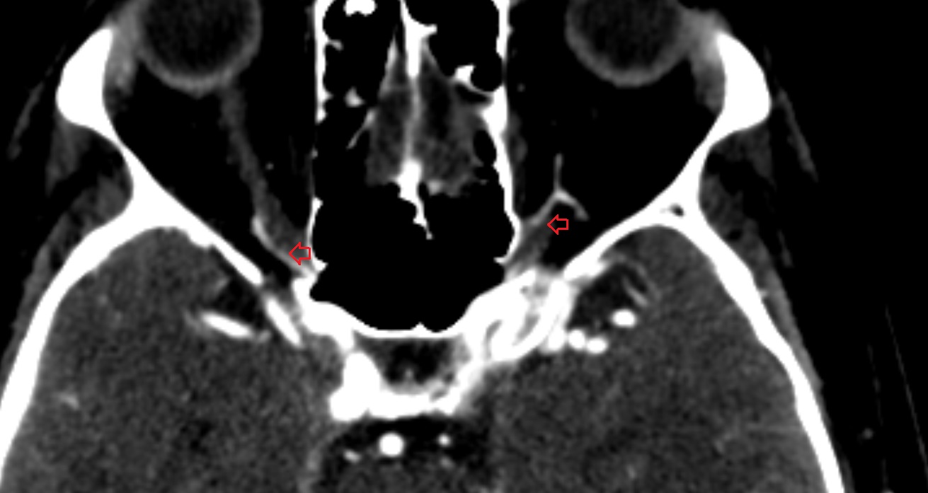 Ophthalmic artery CT axial anatomy image -img-00001-00001