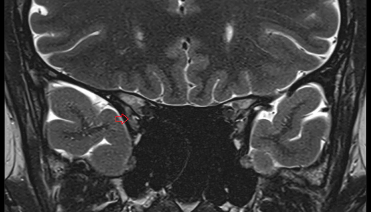 Ophthalmic nerve-img-00000-00000