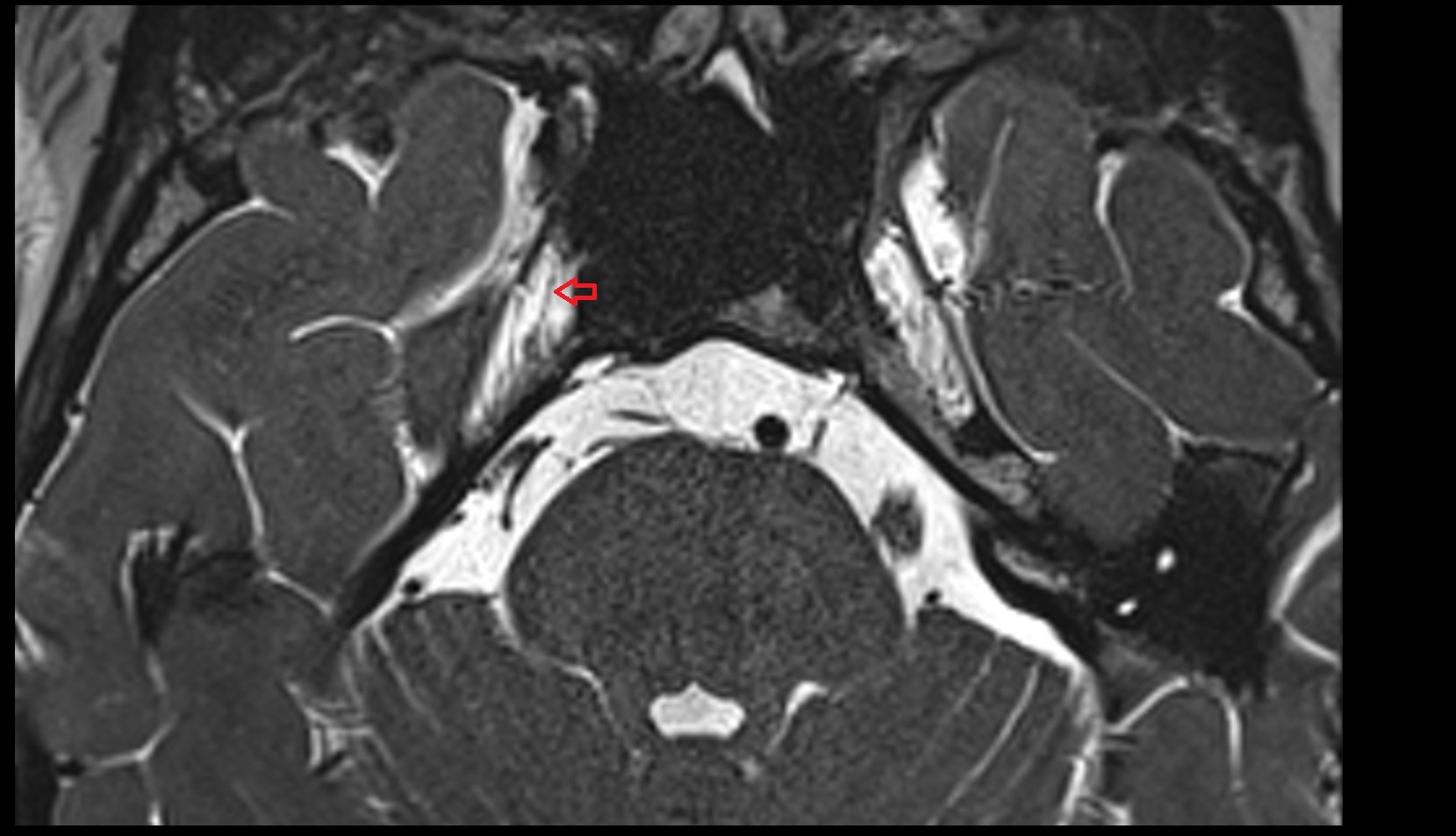 Ophthalmic nerve axial