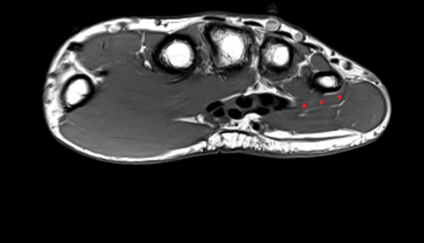 Opponens Digiti Minimi Muscle (Hand)  axial cross sectional anatomy 3T MRI AI enhanced radiology image-img-00000-00000