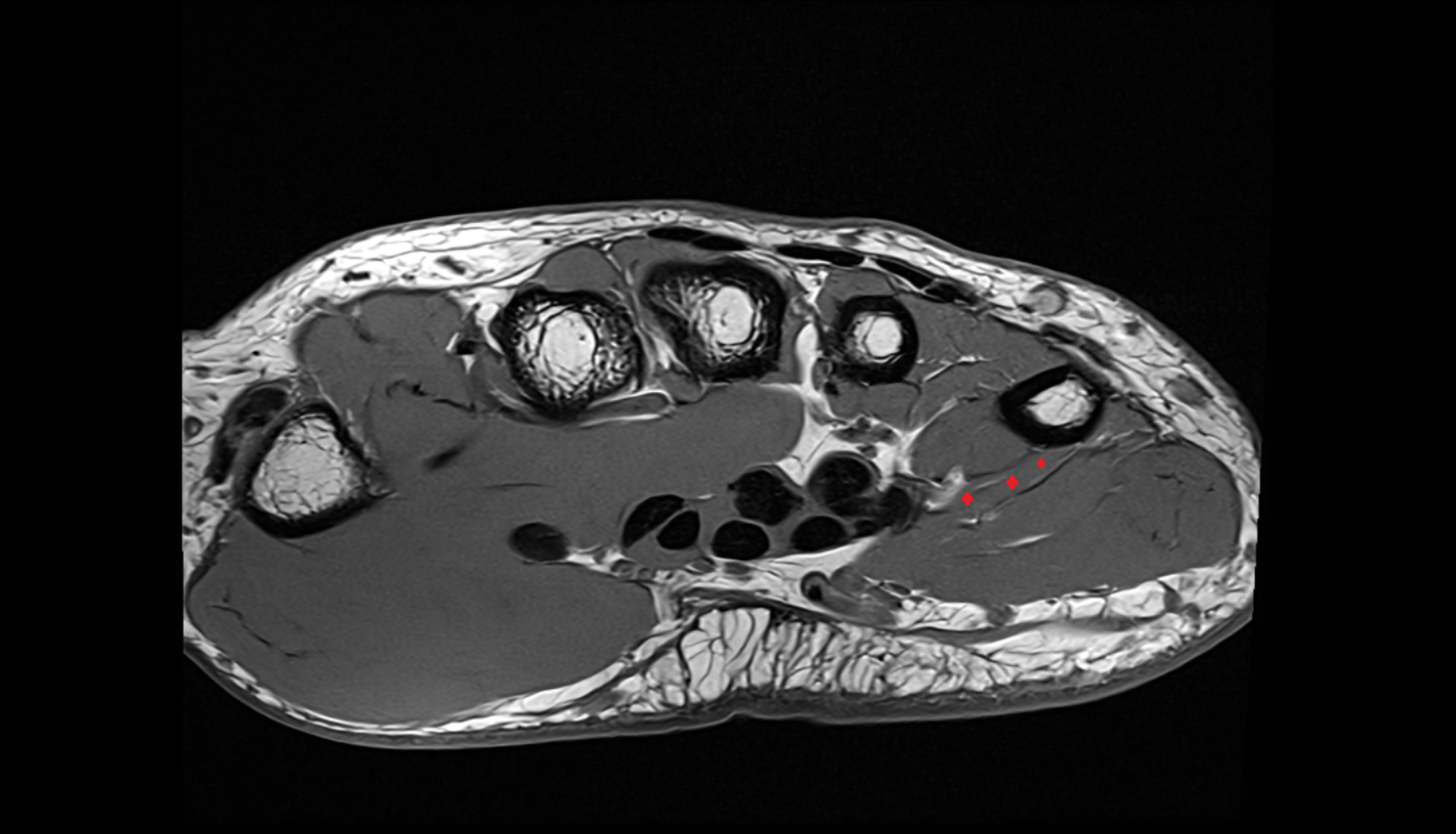 Opponens Digiti Minimi Muscle (Hand)  axial cross sectional anatomy 3T MRI AI enhanced radiology image-img-00000-00000_00001
