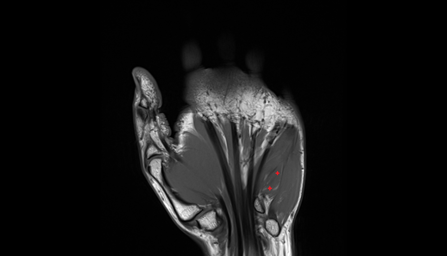 Opponens Digiti Minimi Muscle (Hand)  coronal cross sectional anatomy 3T MRI AI enhanced radiology image-img-00000-00000_00001