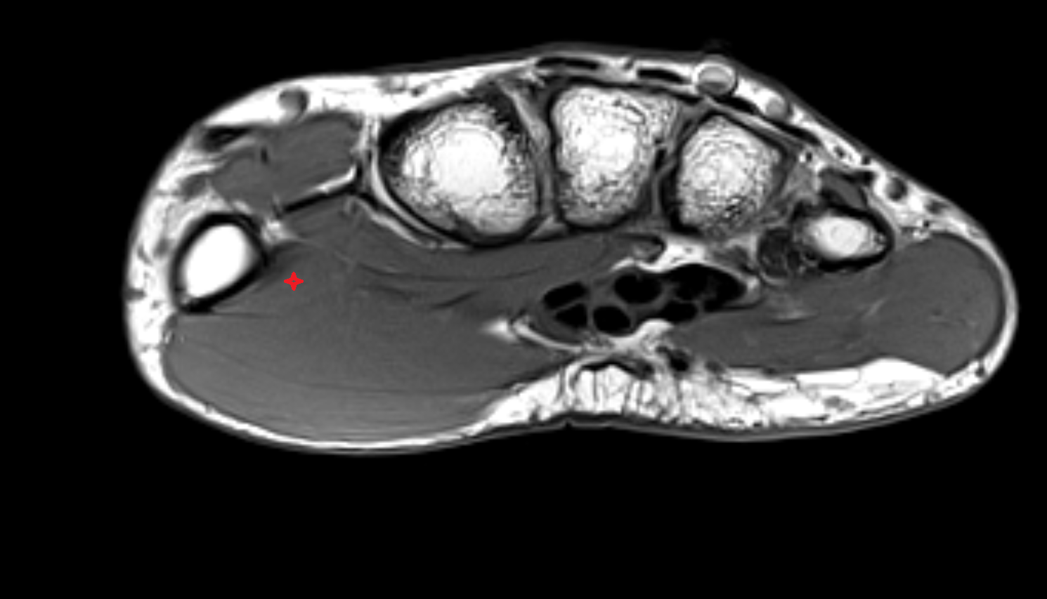Opponens Pollicis Muscle axial cross sectional anatomy 3T MRI AI enhanced radiology image-img-00000-00000