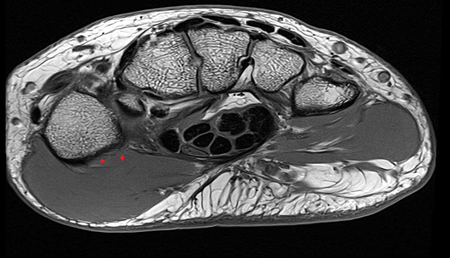 Opponens Pollicis Muscle axial cross sectional anatomy 3T MRI AI enhanced radiology image-img-00000-00000_00001