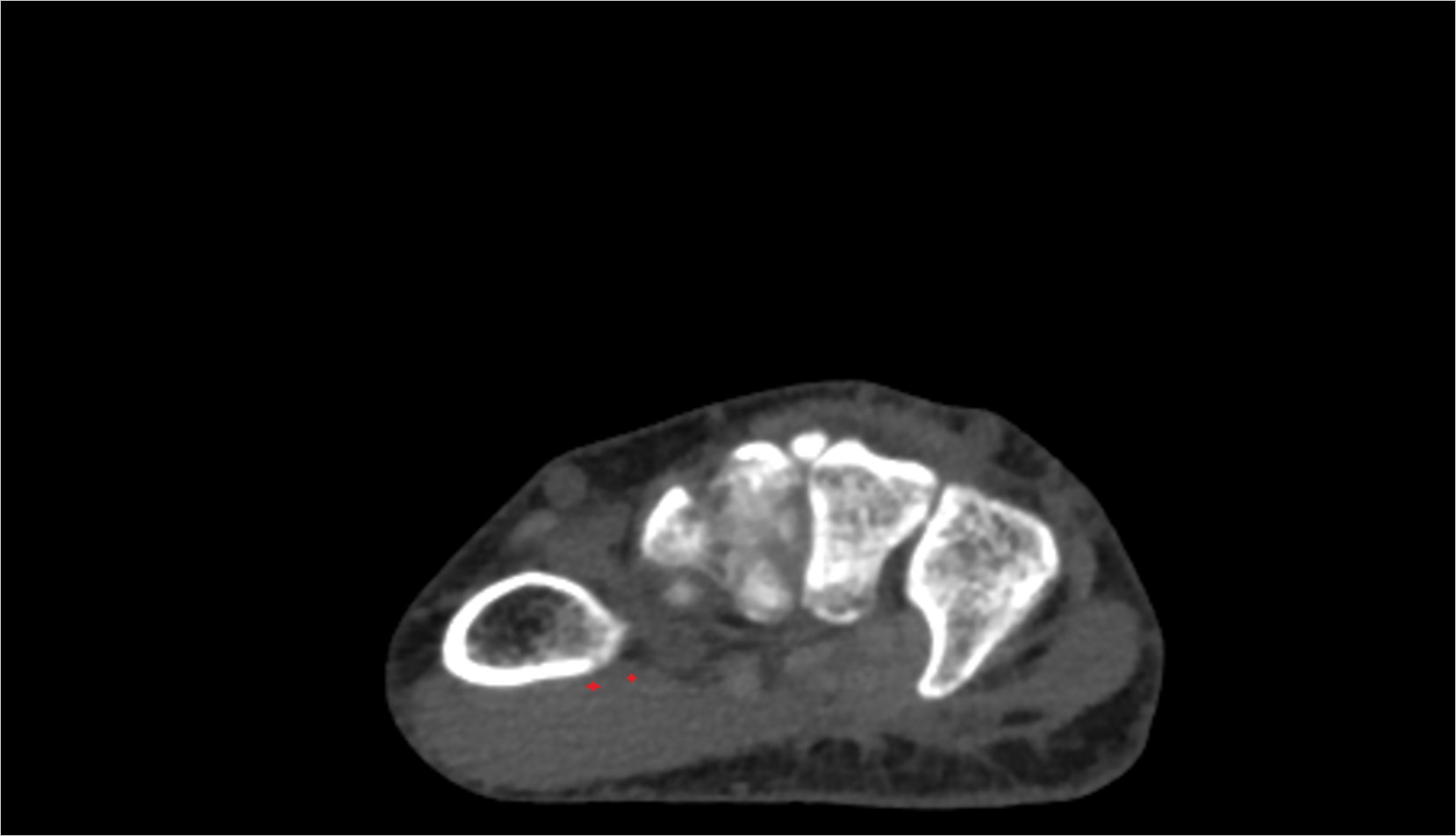 Opponens Pollicis Muscle axial ct image