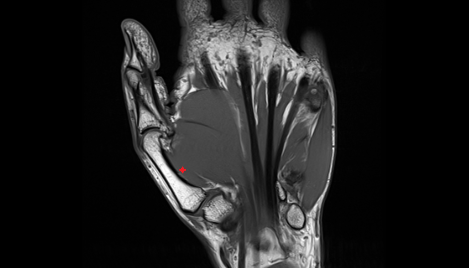 Opponens Pollicis Muscle coronal cross sectional anatomy 3T MRI AI enhanced radiology image-img-00000-00000