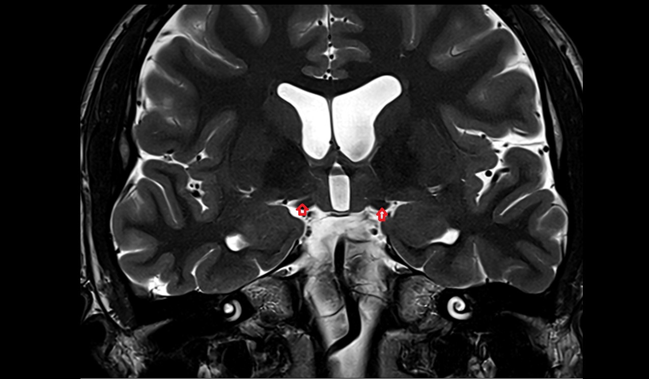 Optic Tract  mri 3t coronal image