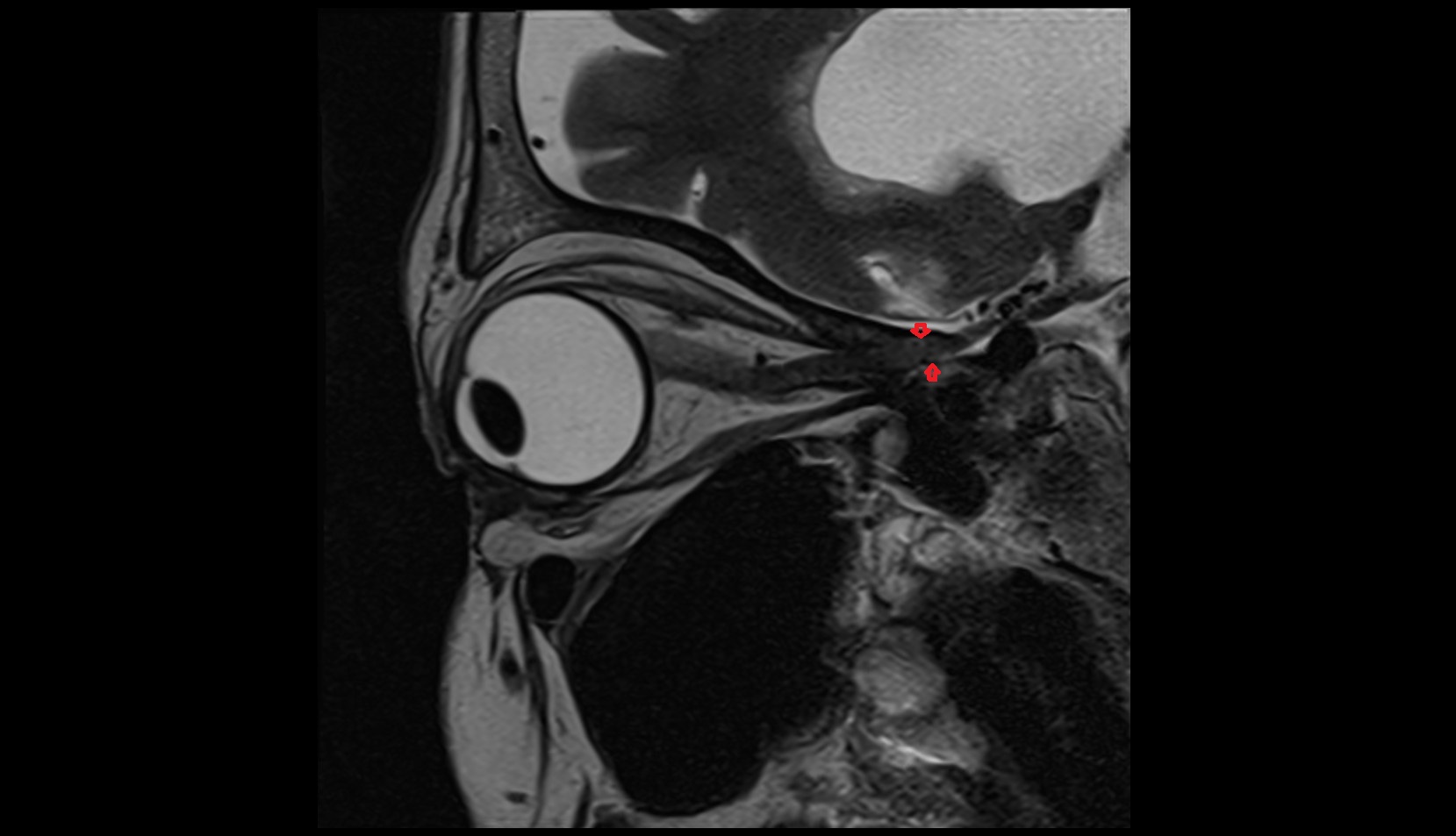 Optic canal mri image